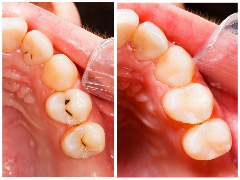 Are white fillings better?