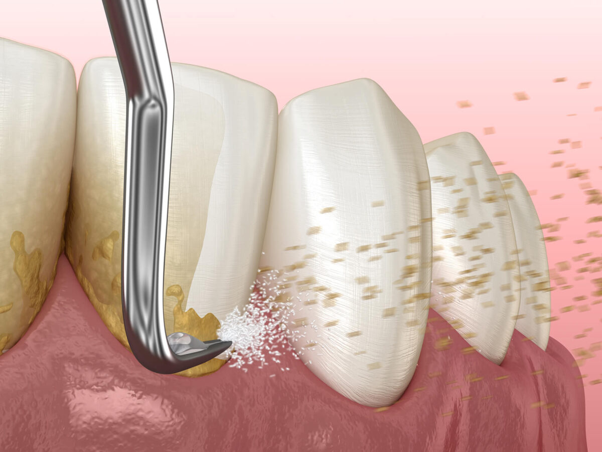 Tartar Removal from Teeth