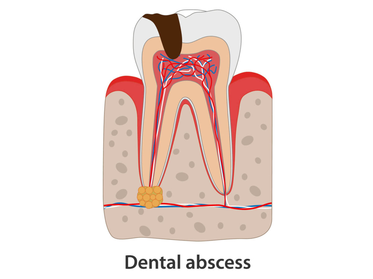 10 Home Remedies For A Tooth Abscess