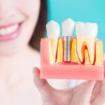 A Permanent Solution: Exploring The Benefits of Dental Implants