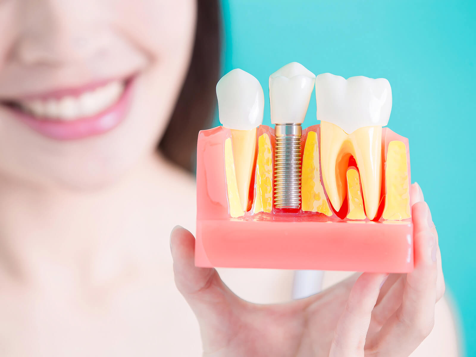 A Permanent Solution: Exploring The Benefits of Dental Implants