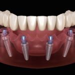 Long-Term Care Tips For Athletes With Dental Implants